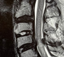 hernia cervical cirujano de columna